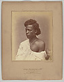 Fistulous Openings in the Jaw and Neck, William H. Bell  American, born England, Albumen silver print from glass negative
