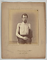 Amputation of the Left Arm for Gunshot Injury, E. J. Ward  American, Albumen silver print from glass negative