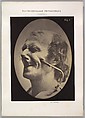 Figure 6: The grimice produced is similar to a tic of the face 
, Guillaume-Benjamin-Amand Duchenne de Boulogne  French, Albumen silver print from glass negative