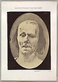 Figure 9: A study of m. frontalis in maximum contraction, Guillaume-Benjamin-Amand Duchenne de Boulogne French, Albumen silver print from glass negative