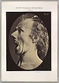 Figure 57: Astonishment, stupefaction, amazement, Guillaume-Benjamin-Amand Duchenne de Boulogne French, Albumen silver print from glass negative