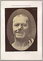 Figure 53: Whimpering and false laughter, Guillaume-Benjamin-Amand Duchenne de Boulogne French, Albumen silver print from glass negative