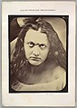 Figure 83: Lady Macbeth, ferocious cruelty, Guillaume-Benjamin-Amand Duchenne de Boulogne  French, Albumen silver print from glass negative