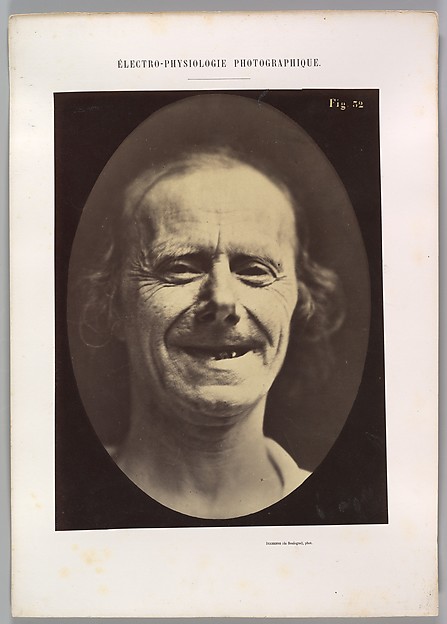 Figure 52: Voluntary retraction of the lower lip