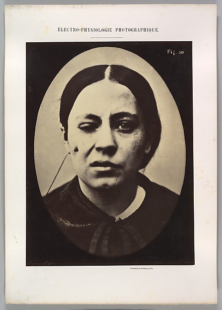 Figure 50: Affected weeping and face in repose